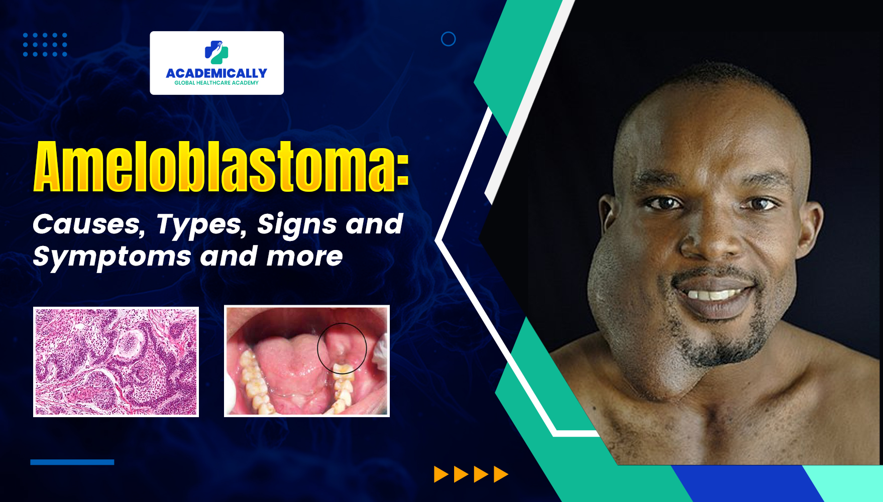 Ameloblastoma A Rare Odontogenic Tumour | Academically